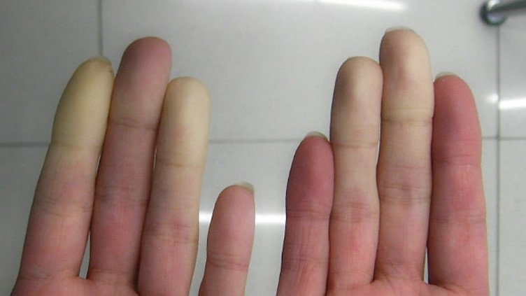 White patches of skin on a person's hand due to Hand-Arm Vibration Syndrome