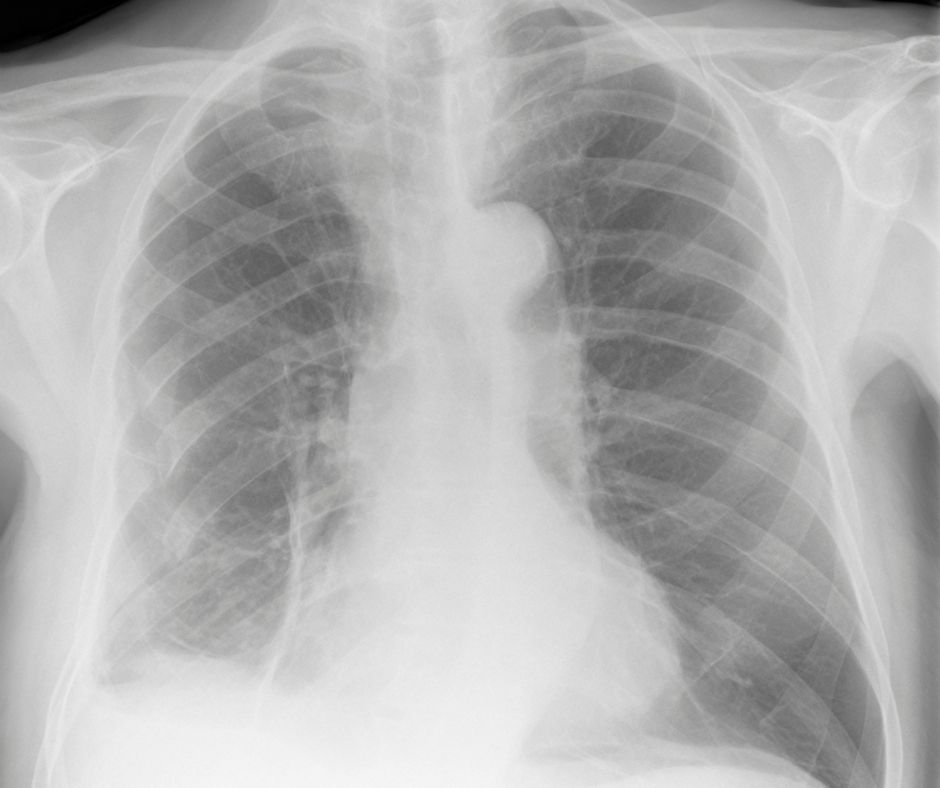 x-ray of ribs