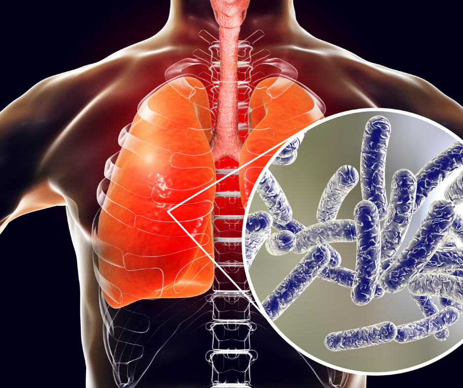 3d generated diagram of legionnaires disease in lungs