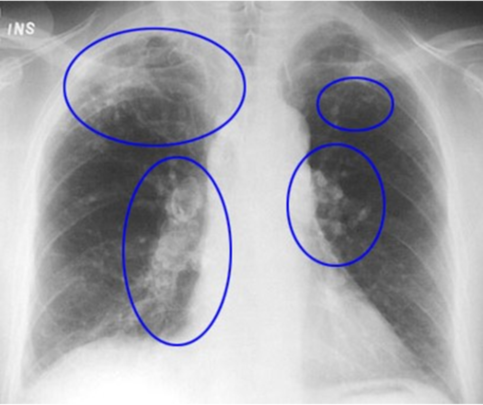 An X-Ray with shadowed areas indicate development of silicosis after prolonged dust exposure. 